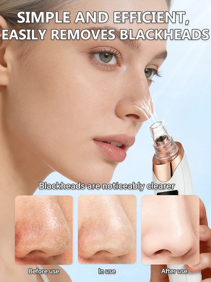 Blackhead remover, pimple and blackhead vacuum cleansing device for facial skin, for deep cleansing at home.